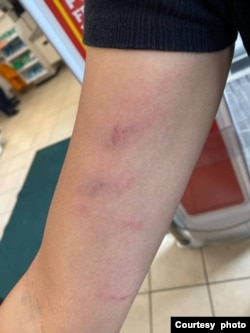 其中一名被袭击的香港人事后展示伤势(照片来源:@carmenkamanlau, Carmen Lau 刘珈汶推特帐号)