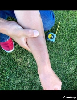 前中国“精神病监狱”受害者界立建不堪在精神病院被折磨,于2018年9月企图割腕自杀解脫。(照片提供:界立建)