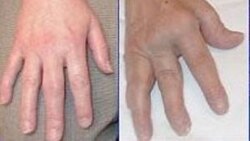 Hỏi đáp Y học: Chứng khớp ngón tay co rút buổi sáng Hỏi đáp Y học: Chứng khớp ngón tay co rút buổi sáng