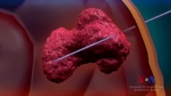 治疗脑癌出现新技术 治疗脑癌出现新技术