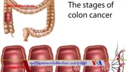 အူမကြီးနဲ့ အစာဟောင်းအိမ်ကင်ဆာ ဘယ်လိုသိနိုင် “လူထုနဲ့ ကျန်းမာရေး” အူမကြီးနဲ့ အစာဟောင်းအိမ်ကင်ဆာ ဘယ်လိုသိနိုင် “လူထုနဲ့ ကျန်းမာရေး”