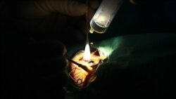 Biến chứng sau khi mổ cataract Biến chứng sau khi mổ cataract