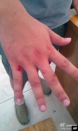 南都记者采访中挨打,手部受伤