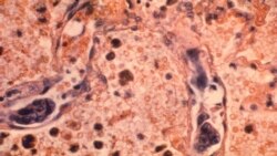 ကိုဗစ်နဲ့ အဆုပ်ရောဂါအခံ ကိုဗစ်နဲ့ အဆုပ်ရောဂါအခံ