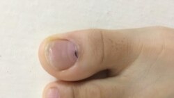 Vết đen dưới móng chân Vết đen dưới móng chân