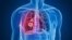 lung cancer အဆုတ်ကင်ဆာ