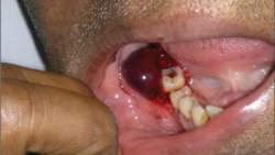 Máu trong nước bọt Máu trong nước bọt