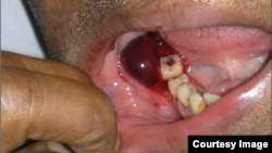 Máu trong nước bọt