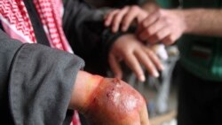 ကြွက်နို့ အရေးပြားရောဂါ ကြွက်နို့ အရေးပြားရောဂါ